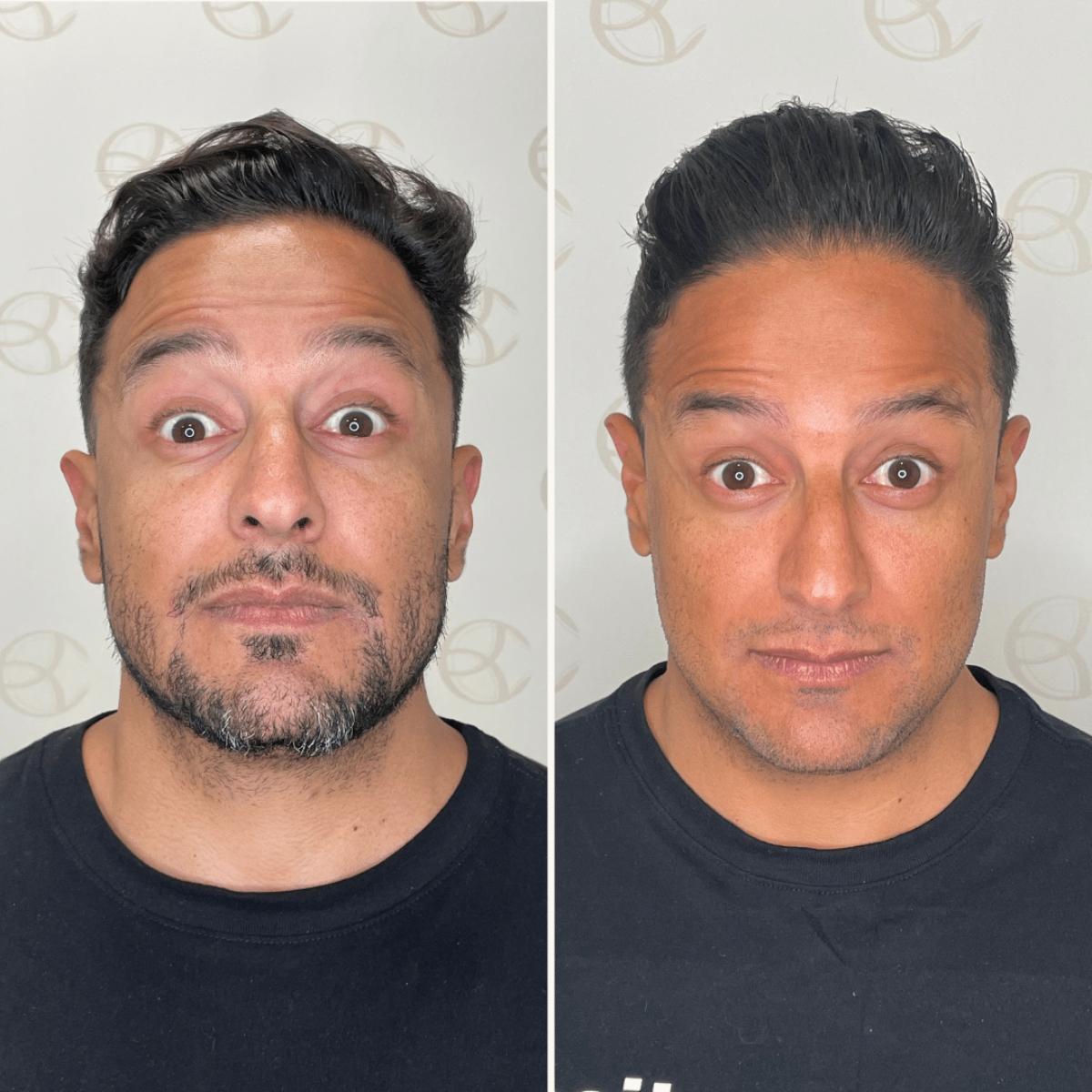 Antes e depois toxina botulínica